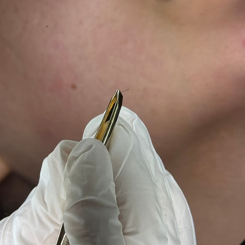 Geste thermolyse poils visage menton praticienne