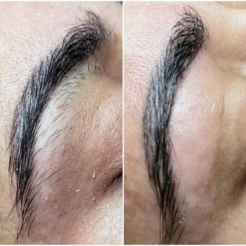 avant après thermolyse épilise résultat réel