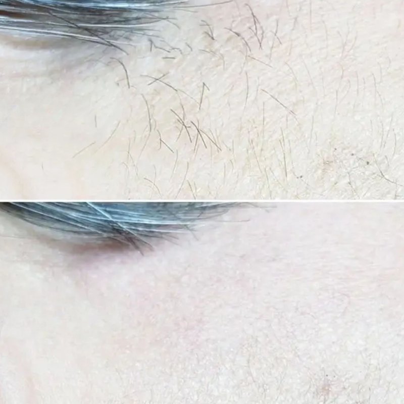 avant après thermolyse épilise résultat réel