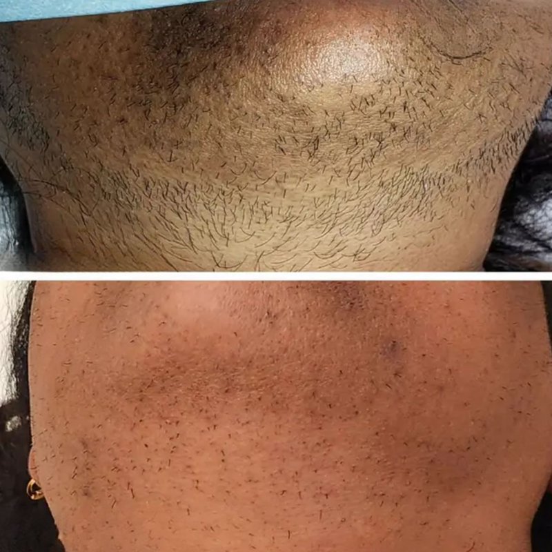 avant après thermolyse épilise résultat réel