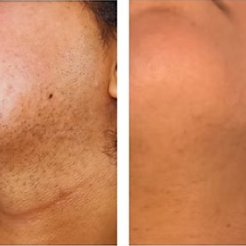 avant après thermolyse épilise résultat réel