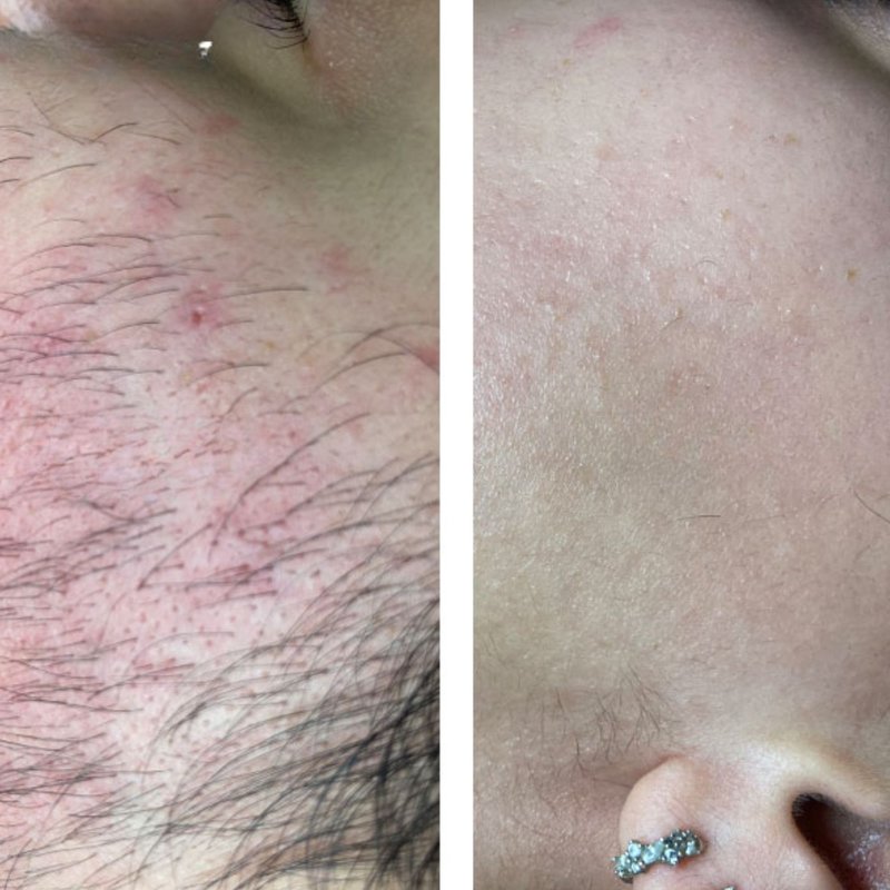 avant après thermolyse épilise résultat réel