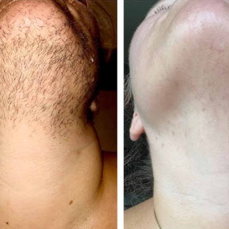 avant après thermolyse épilise résultat réel