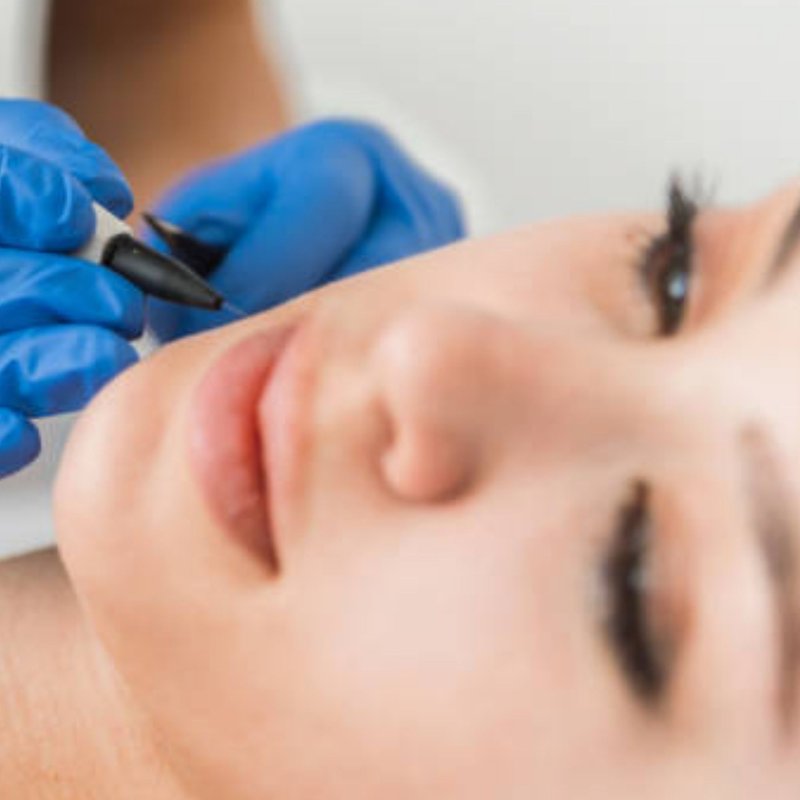 avant après thermolyse épilise résultat réel