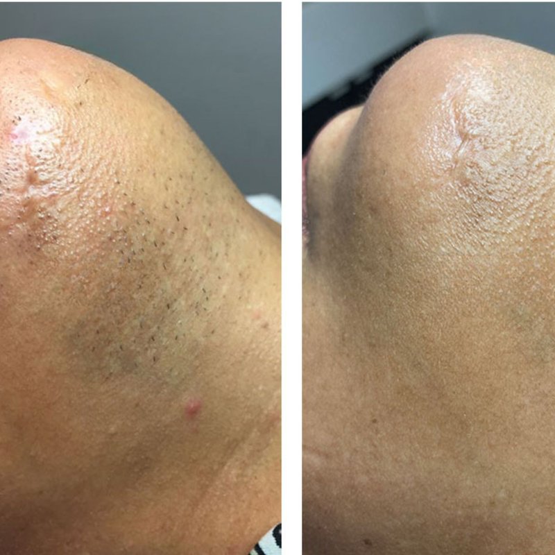 avant après thermolyse épilise résultat réel