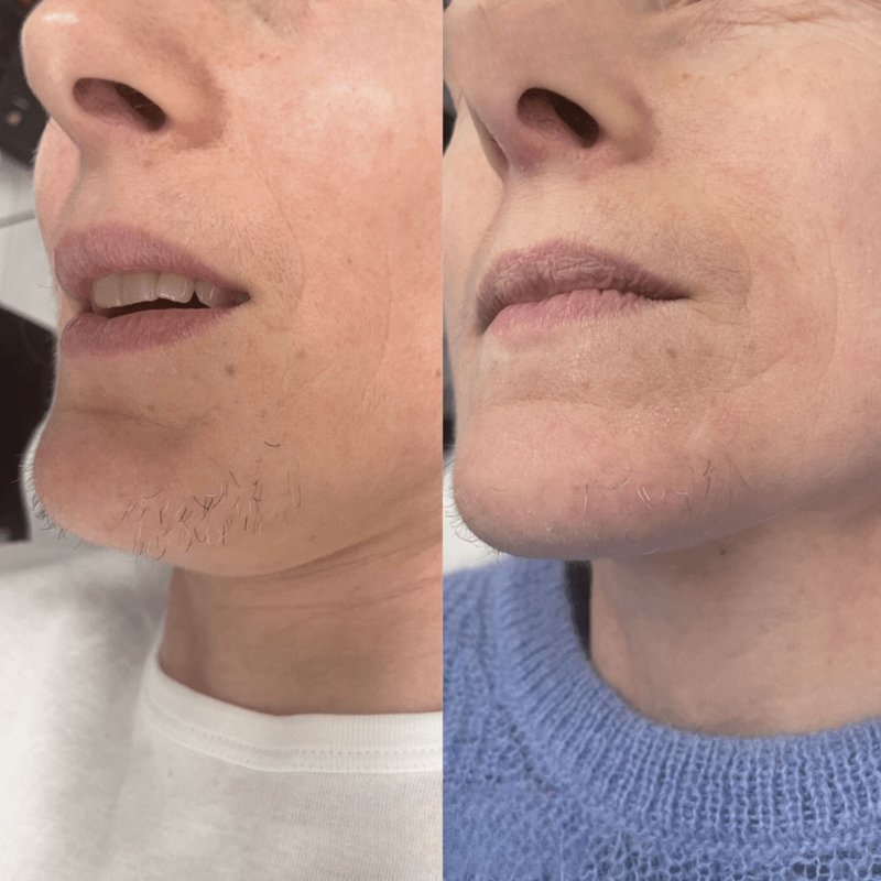 avant après thermolyse épilise résultat réel