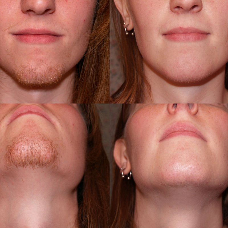 avant après thermolyse épilise résultat réel