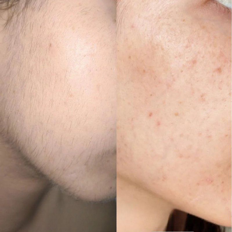 avant après thermolyse épilise résultat réel