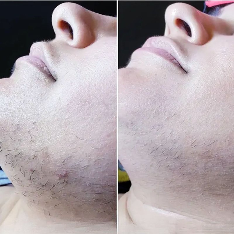 avant après thermolyse épilise résultat réel