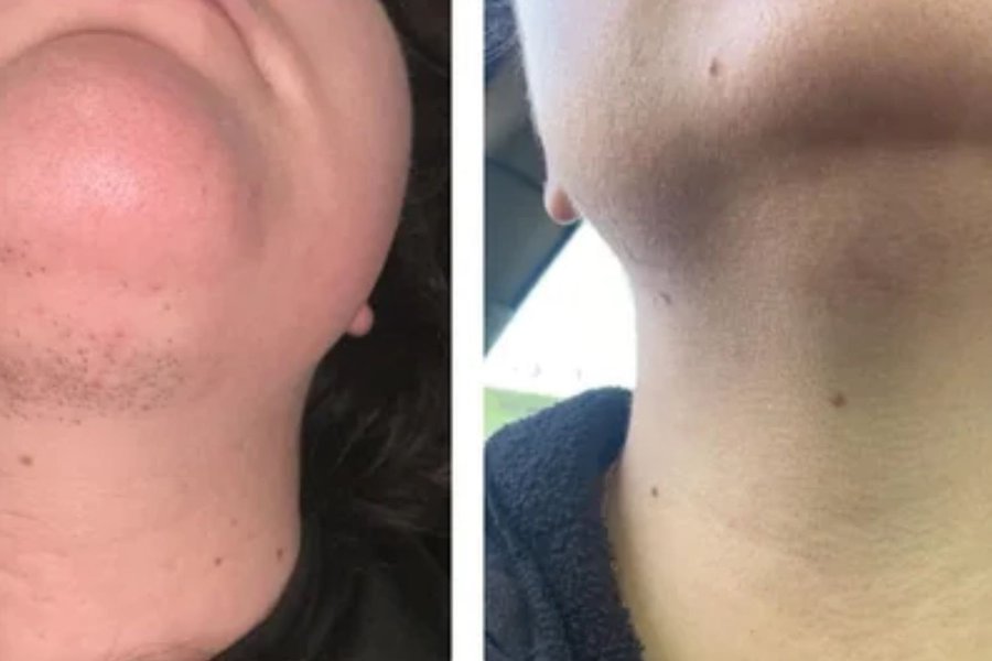 avant après thermolyse transition hormonale joue menton