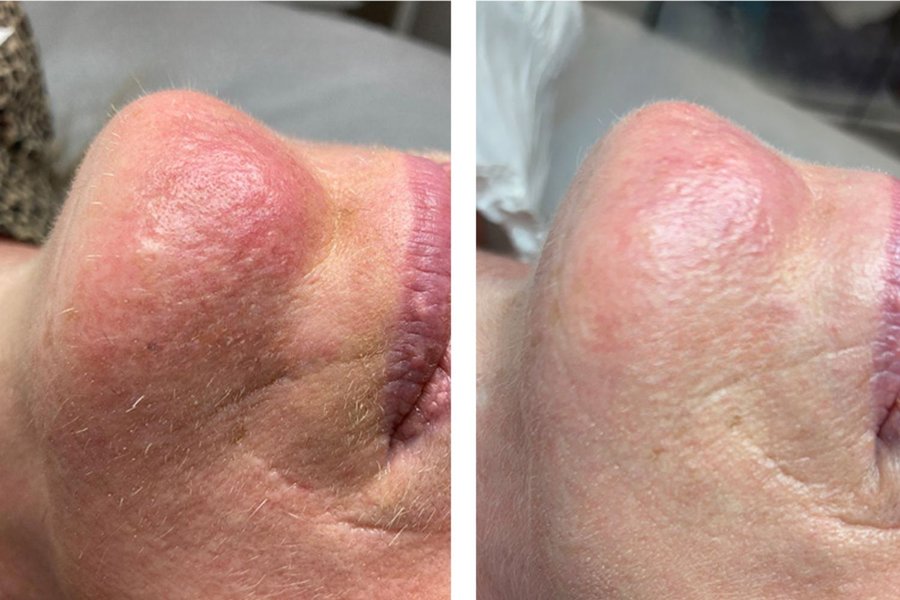 avant après thermolyse homme senior nez menton