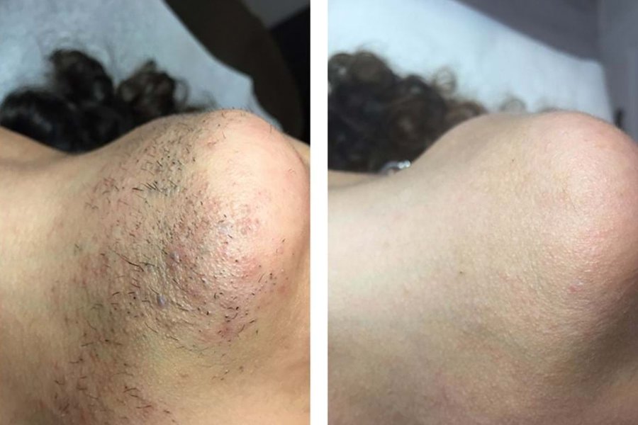 avant après thermolyse menton cou poils incarnés résultat