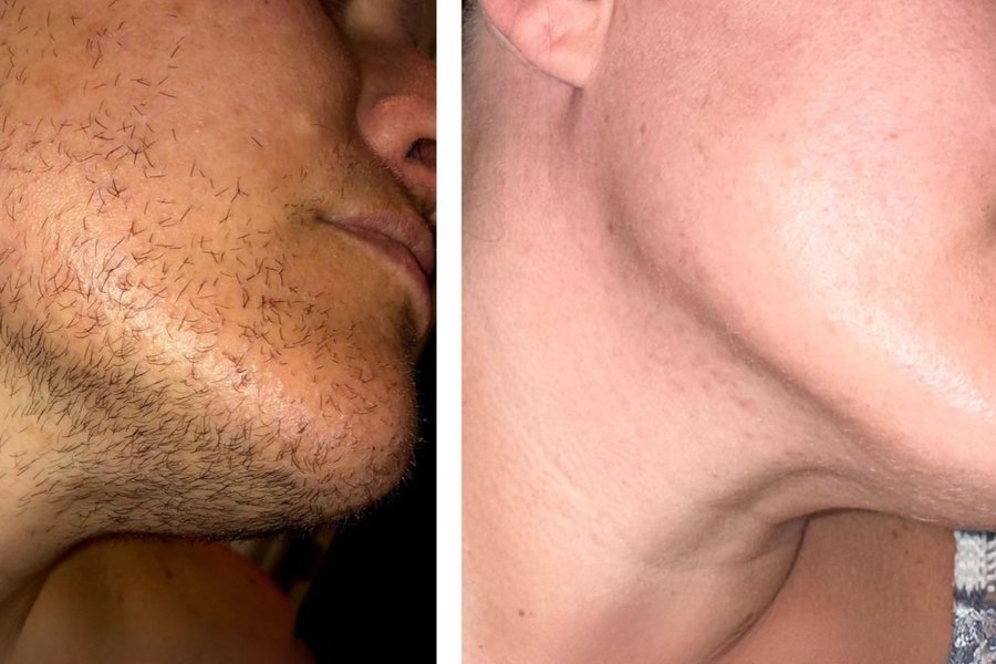 avant après thermolyse homme joue résultat