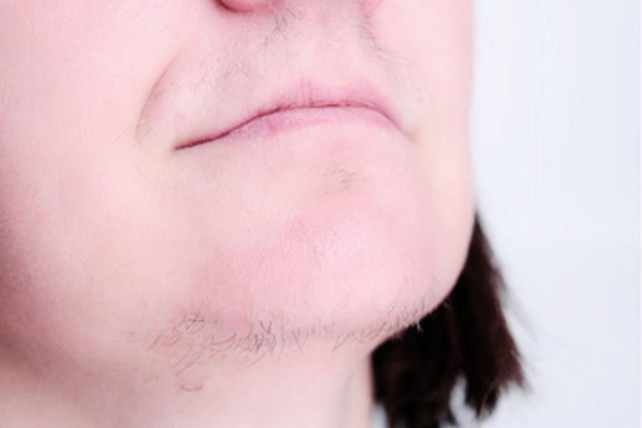 avant thermolyse hirsutisme menton lèvre profil femme