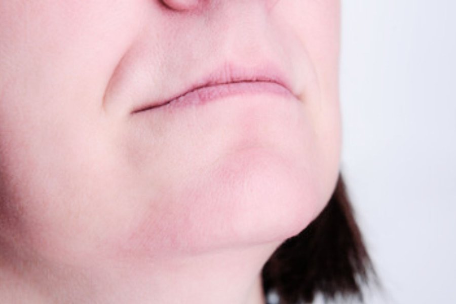 après thermolyse résultat menton propre femme profil