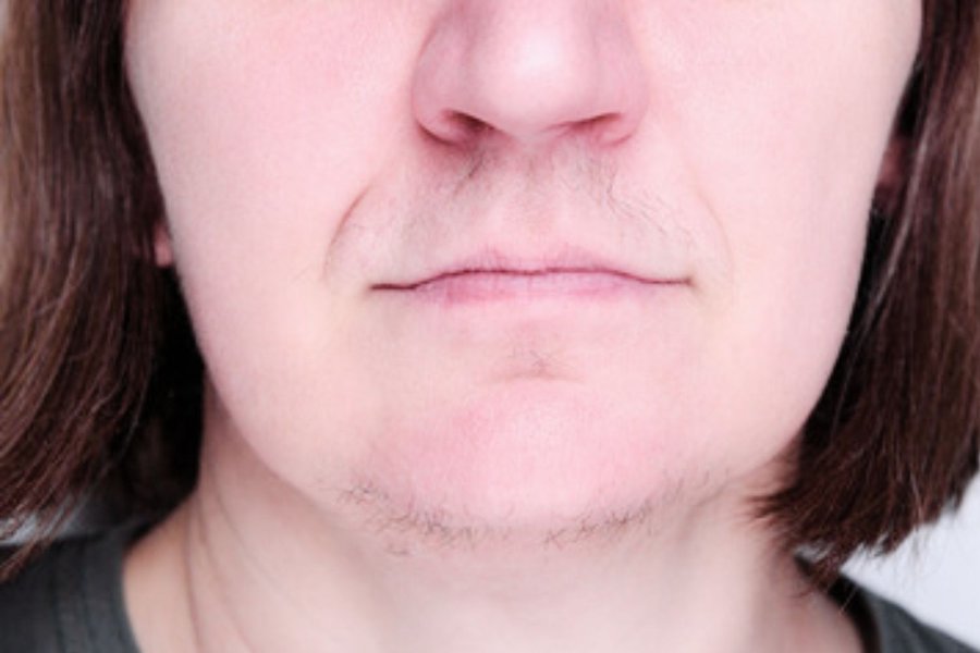 avant thermolyse hirsutisme menton lèvres visage femme