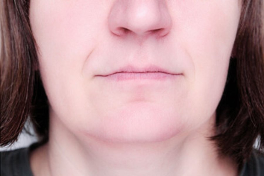 après thermolyse résultat menton propre visage femme