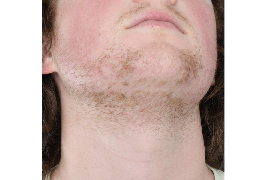 avant thermolyse hirsutisme menton cou poils roux femme
